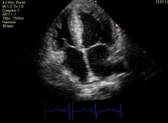 Four chambers of the heart imaged as an echocardiogram.